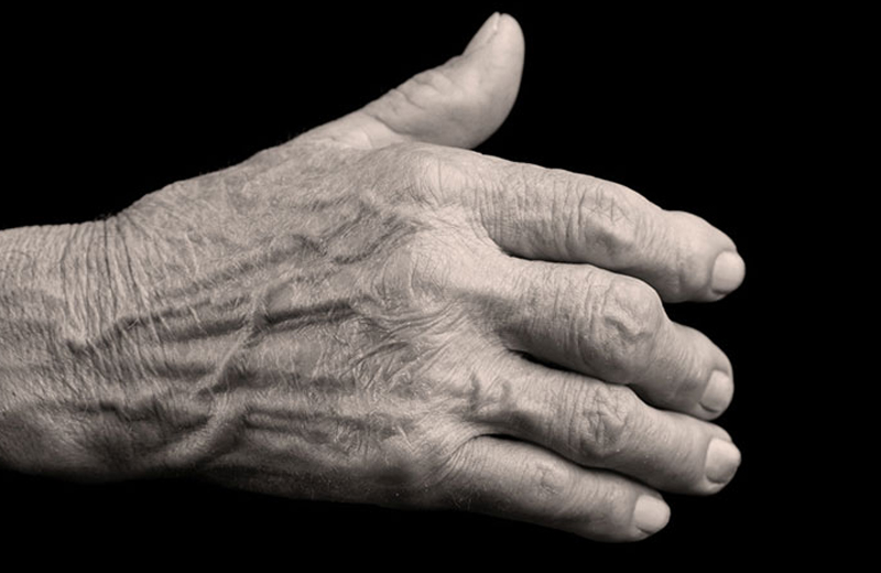Hand-symptoms_deformity