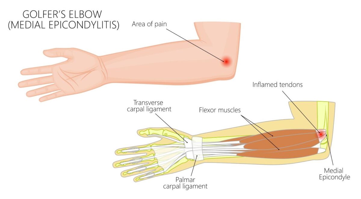 Golfer's elbow