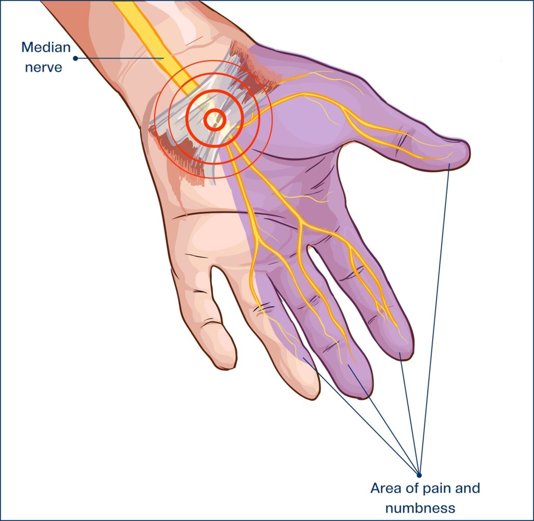 Carpal Tunnel - Hand Pain - Orlando Hand Surgery Associates