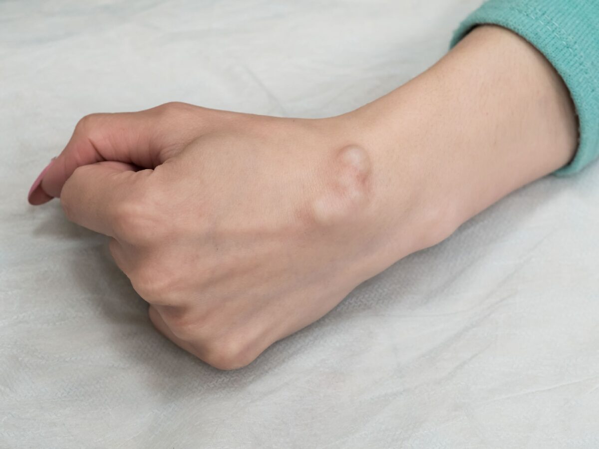 ganglion cyst of the wrist fluid filled bump