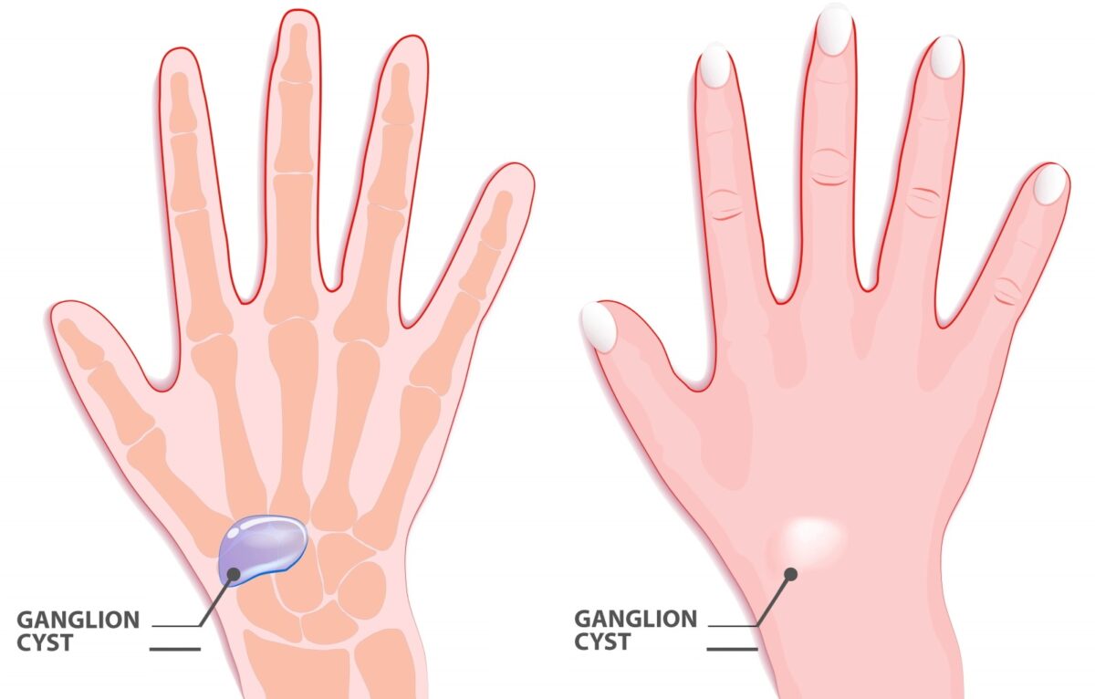 ganglion cyst of the wrist illustration