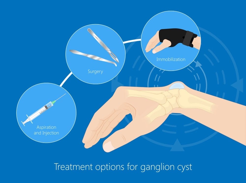 ganglion cyst of the wrist treatments