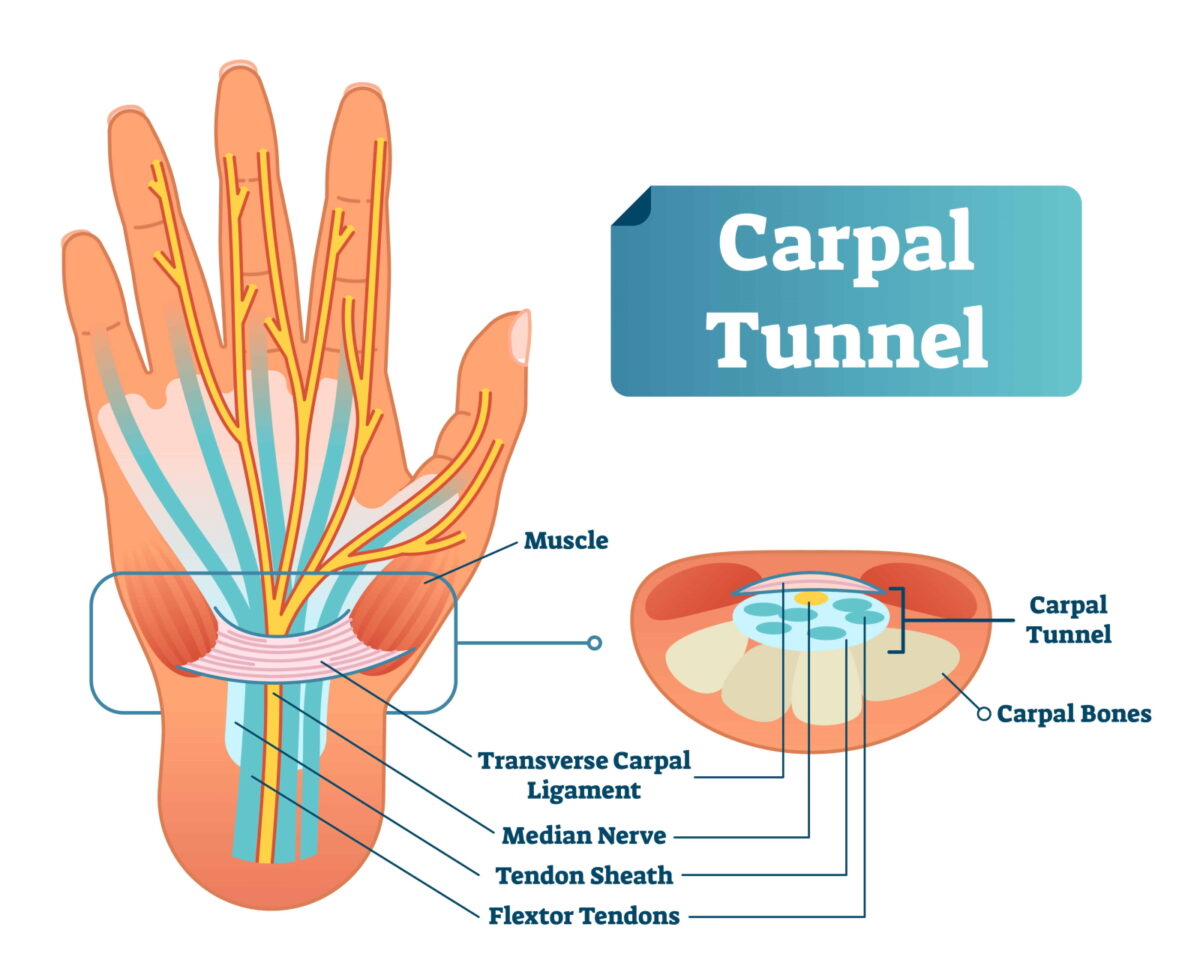carpal tunnel syndrome illustration