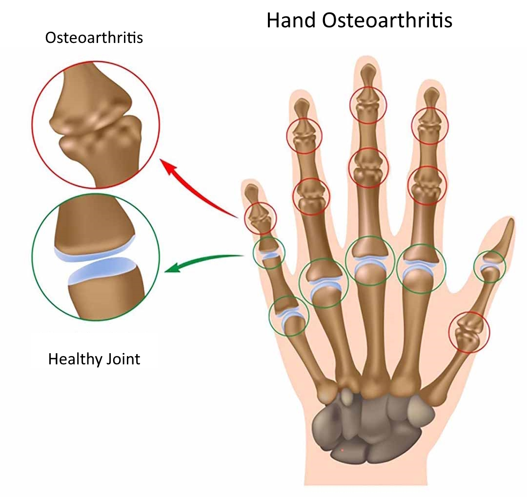 hand osteoarthritis symptoms illustration