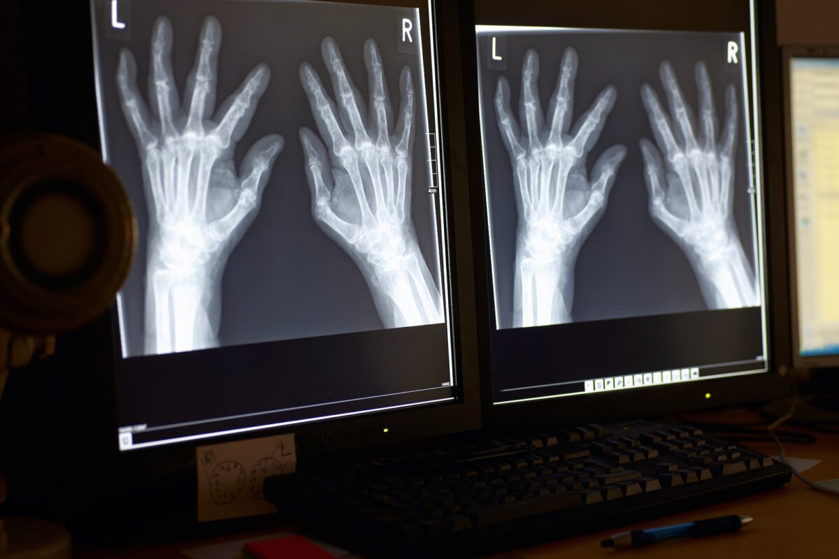 osteoarthritis symptoms X-ray of four hands