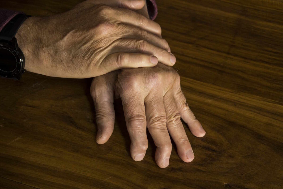 arthritis symptoms hands