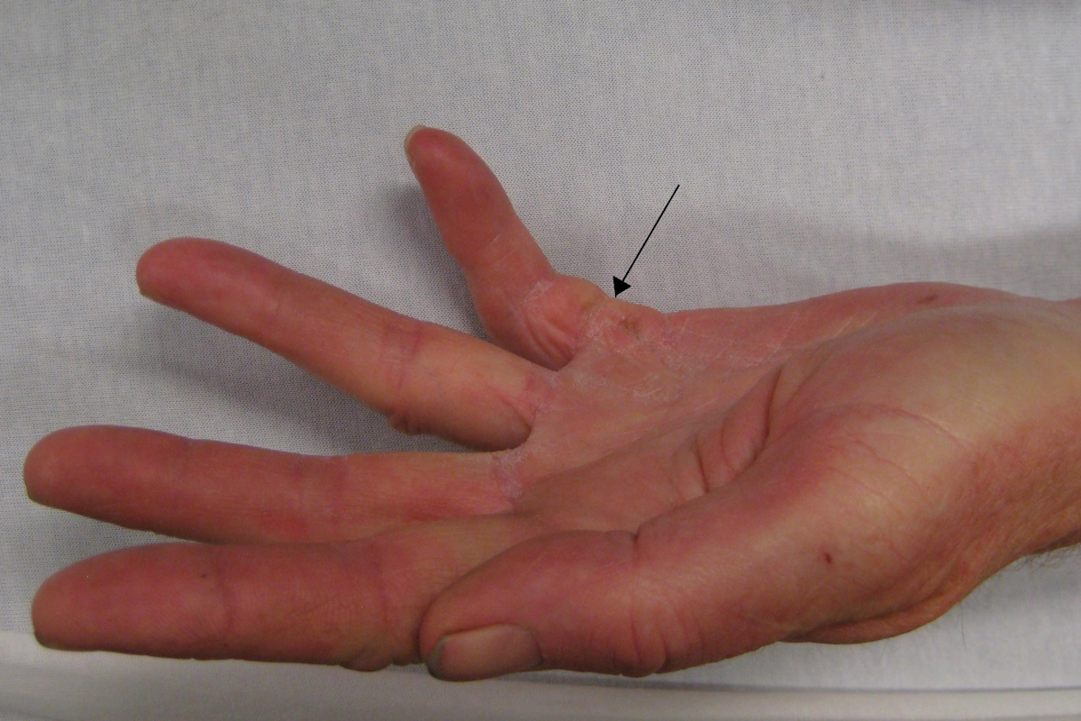 Dupuytren’s Disease of the Hand