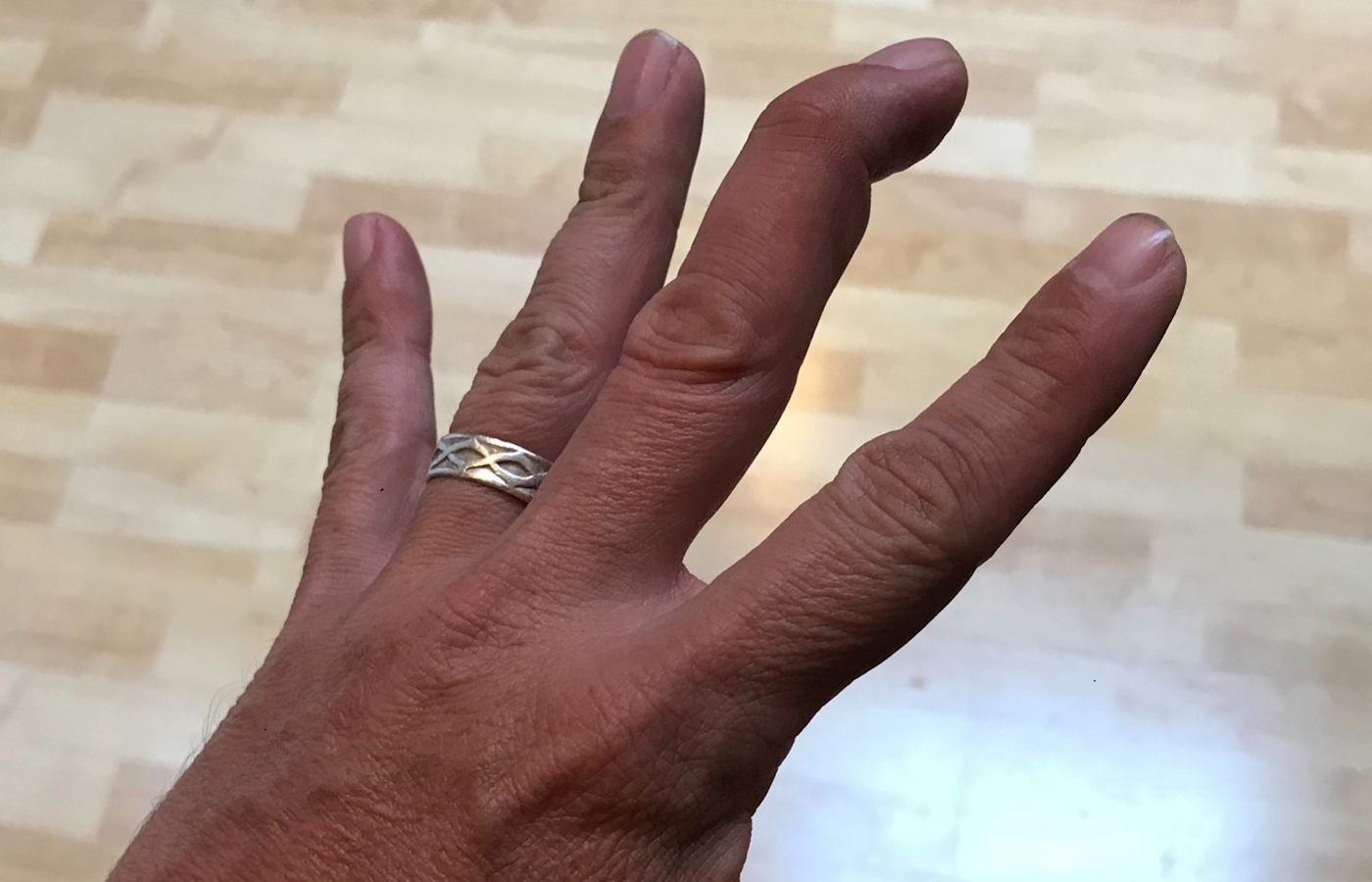 Trigger Finger (Stenosing Tenosynovitis) | Arthritis-health