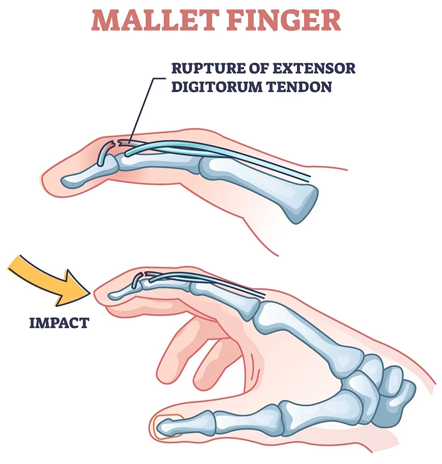 mallet finger illustration