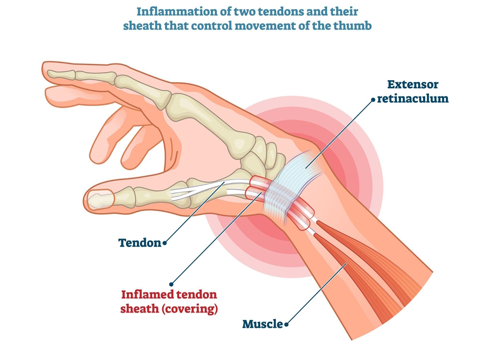 De Quervain’s tendinitis illustration