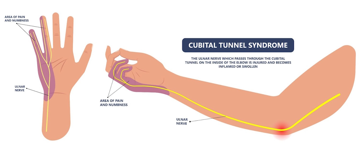 ulnar nerve entrapment illustration