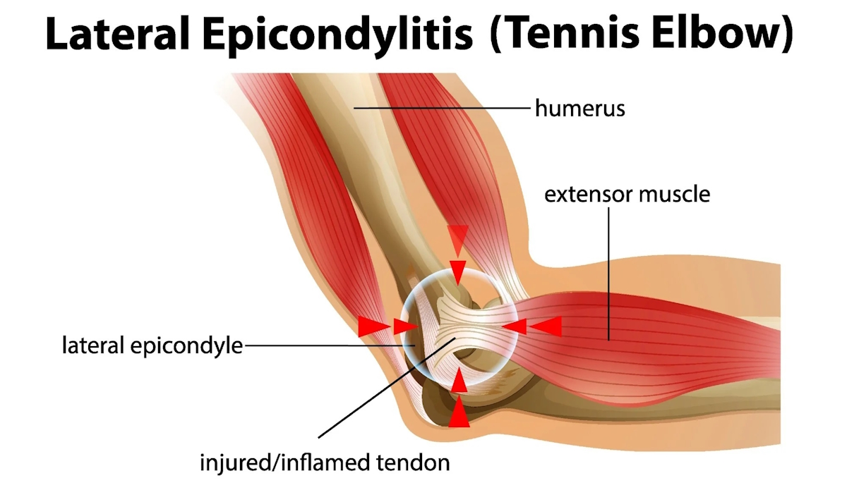 elbow tendonitis lateral epicondylitis or tennis elbow illustration