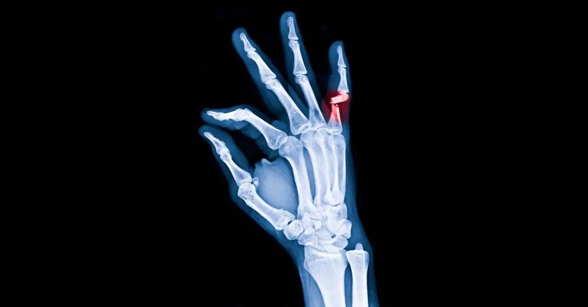 Signs Of Bone Fracture In Finger
