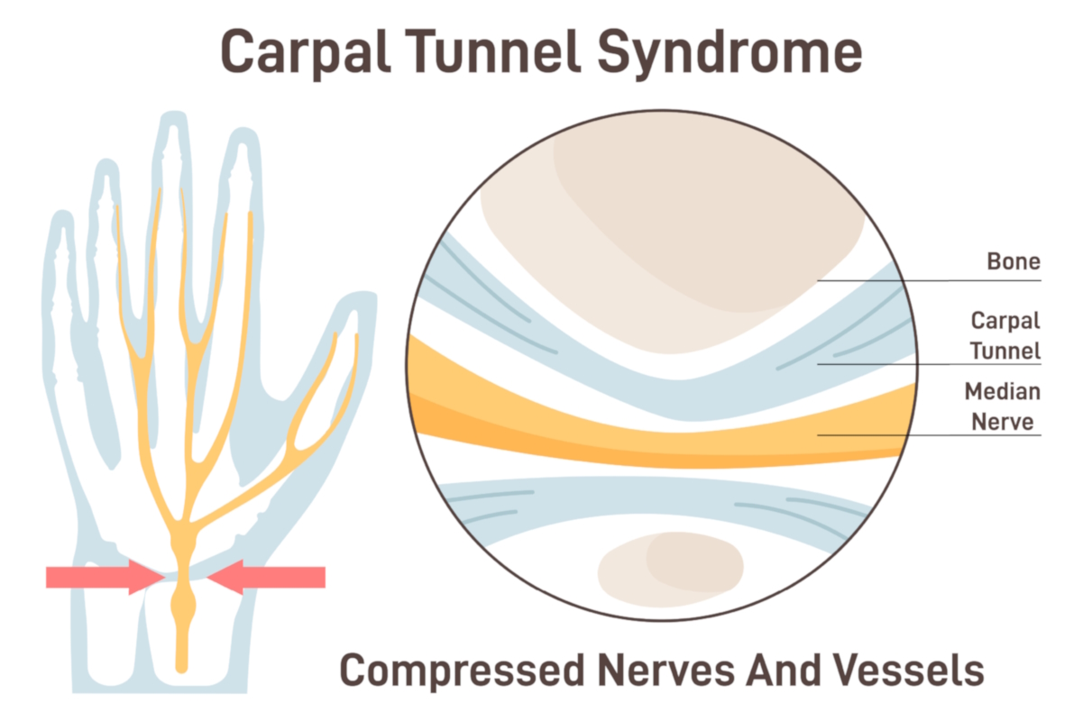 hand disorders illustration carpal tunnel