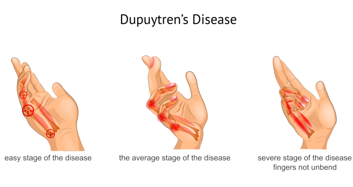 hand disorders illustration dupuytrens disease