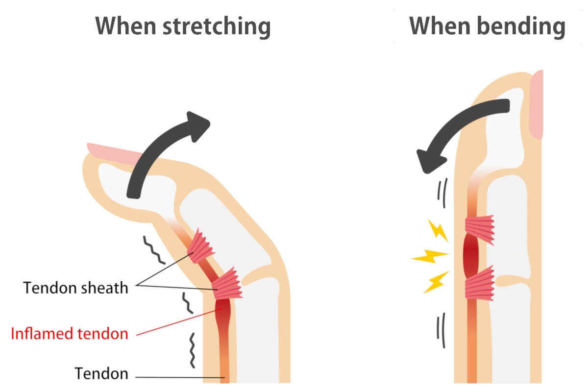 hand disorders illustration trigger finger