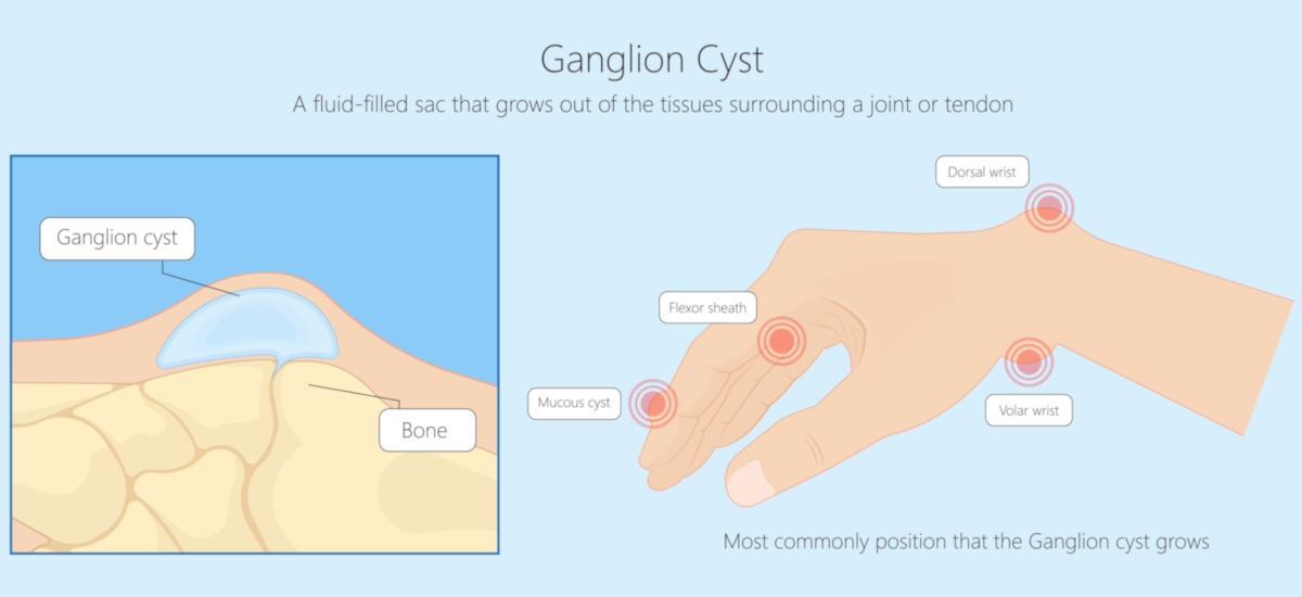 illustration ganglion cyst