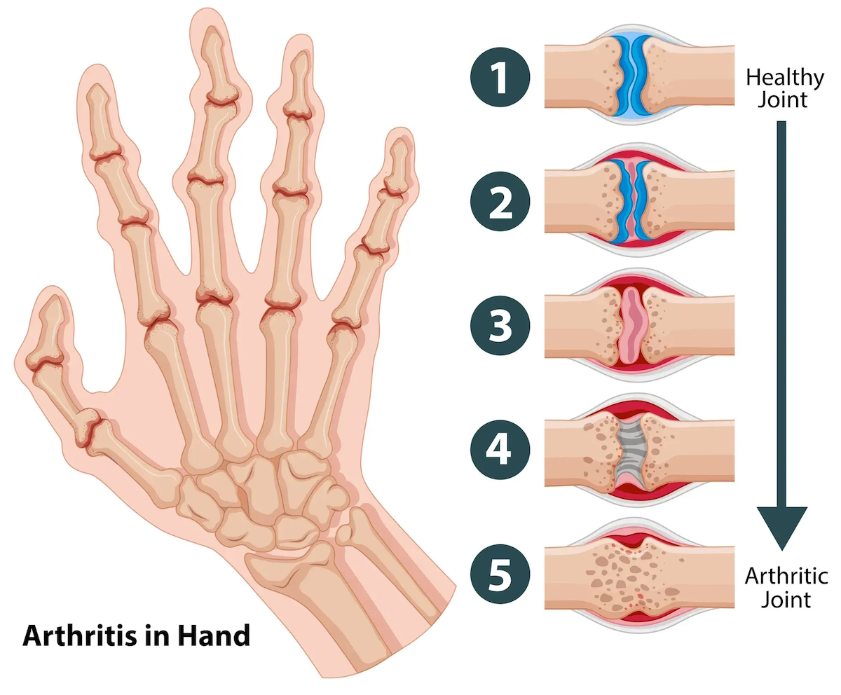 orthopedic hand doctor illustration arthritis