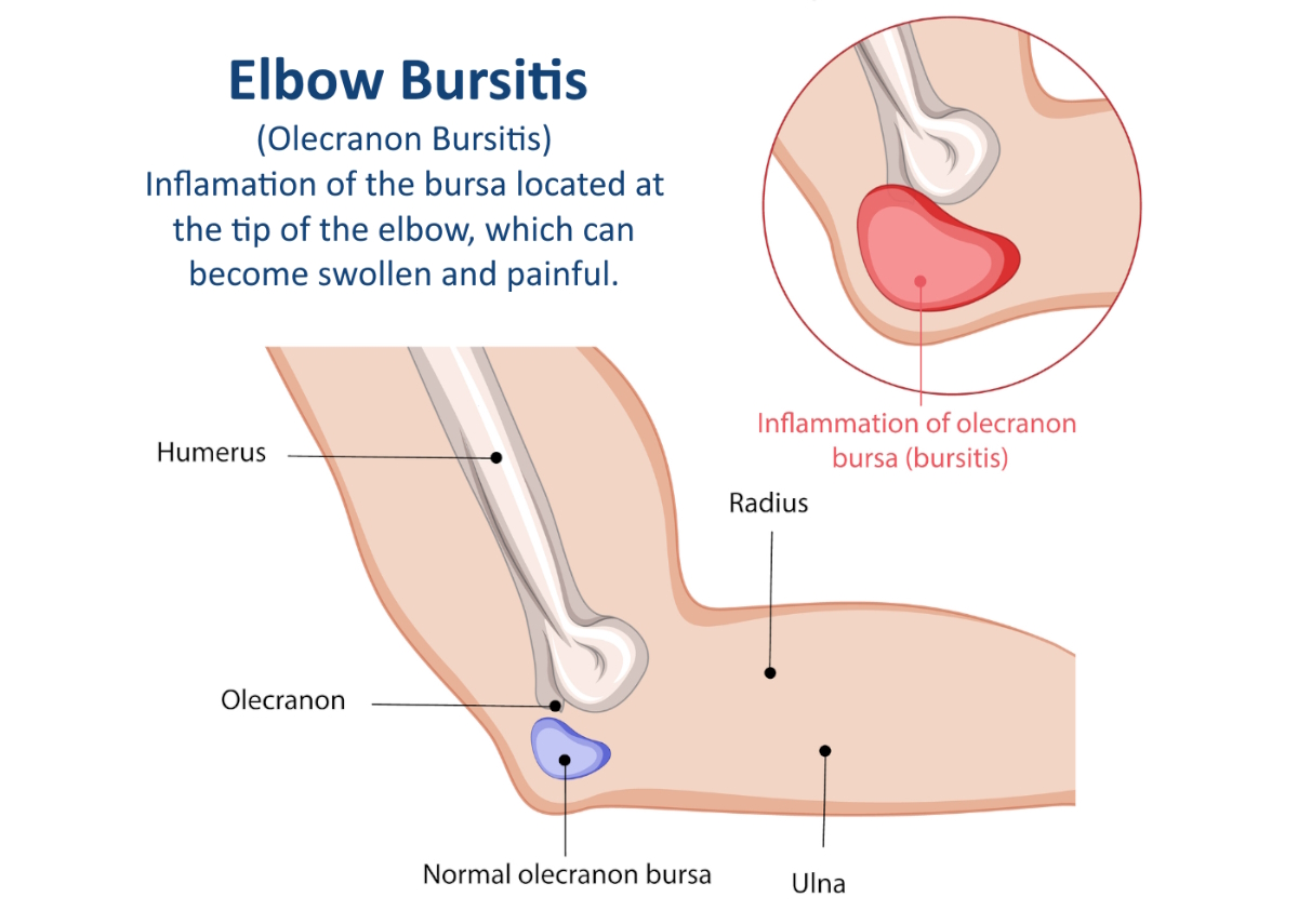 elbow pain illustration inflammation of bursa in elbow