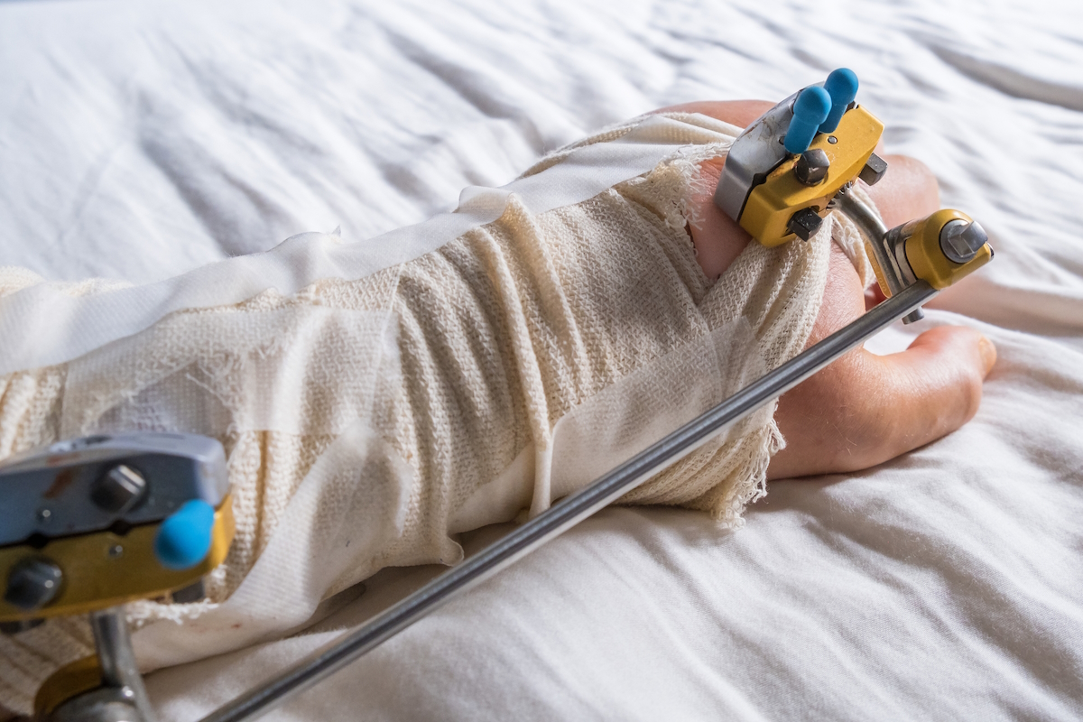wrist fracture surgery external fixation surgery insert wires or metal pins into the bone istock2248980987