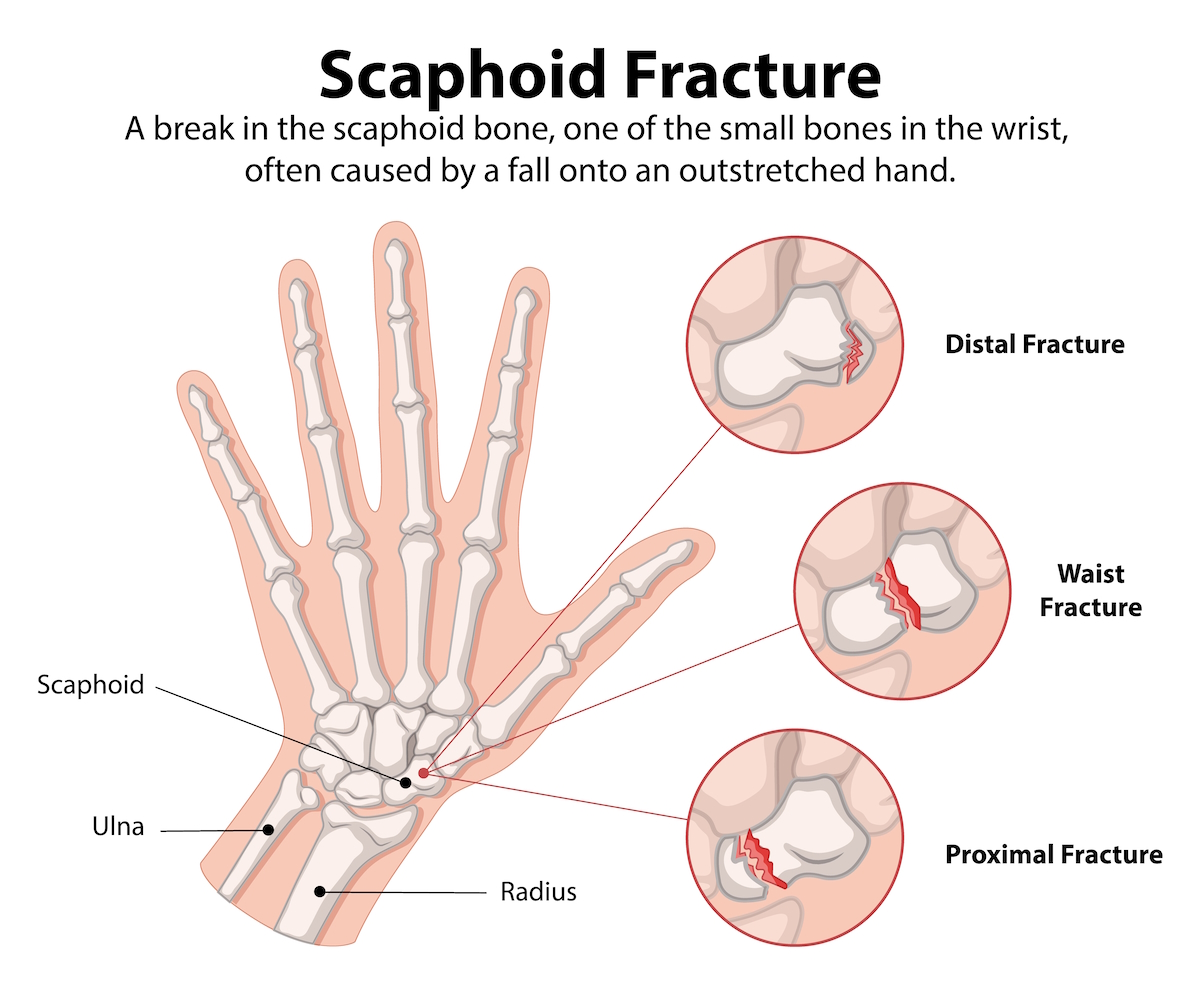 wrist fracture surgery illustration scaphoid bone fractures