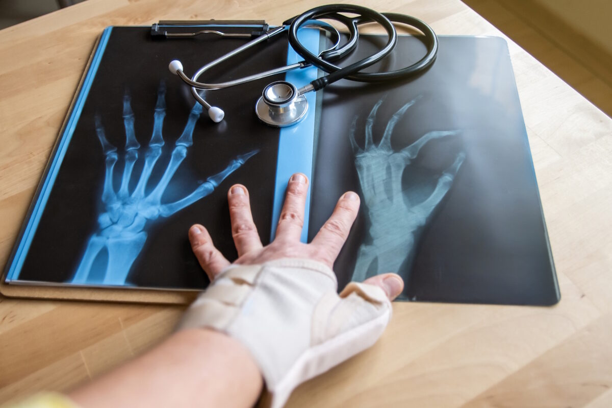 wrist fracture surgery x rays fractures bandaged hand