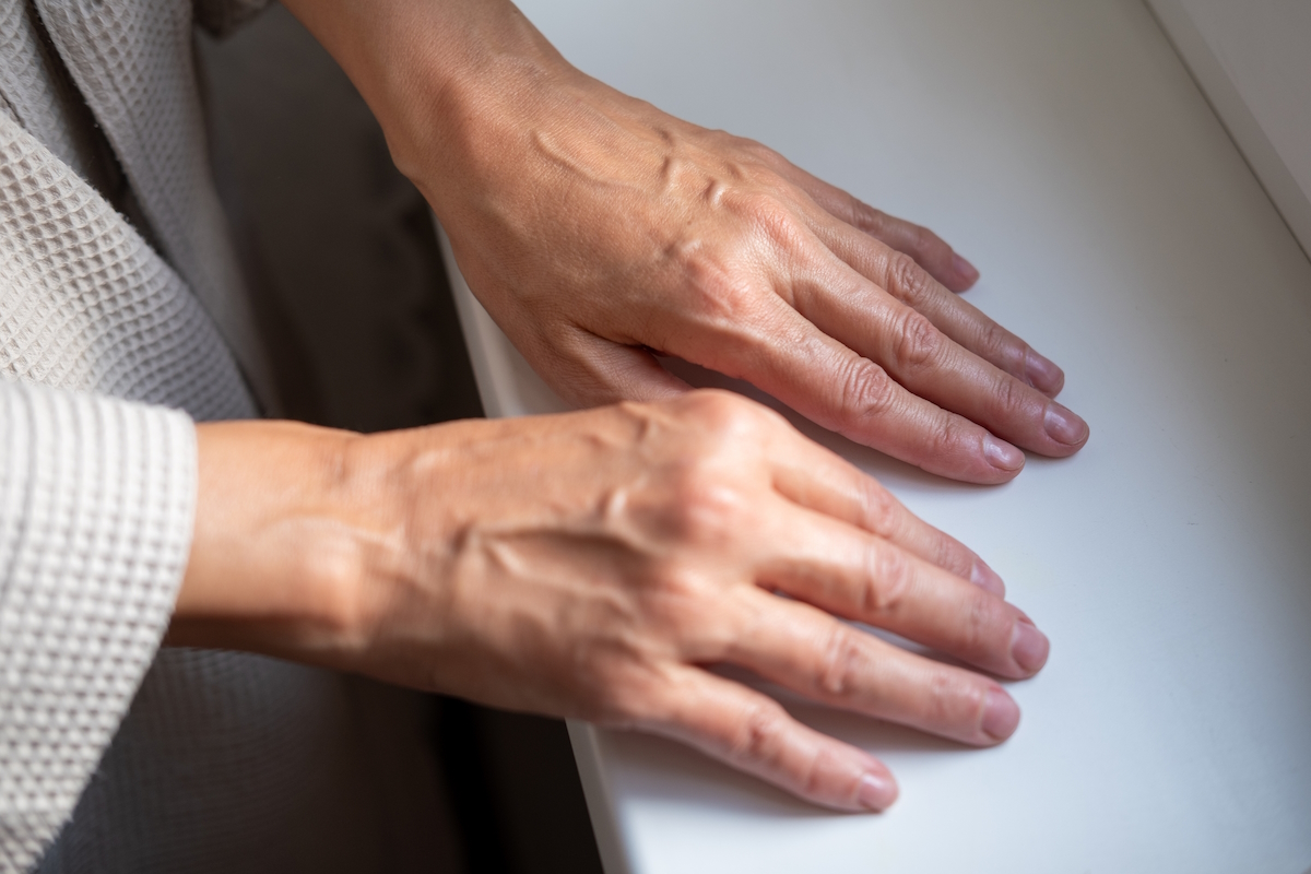 rheumatoid arthritis hands of 50s woman swollen veins istock2179912270